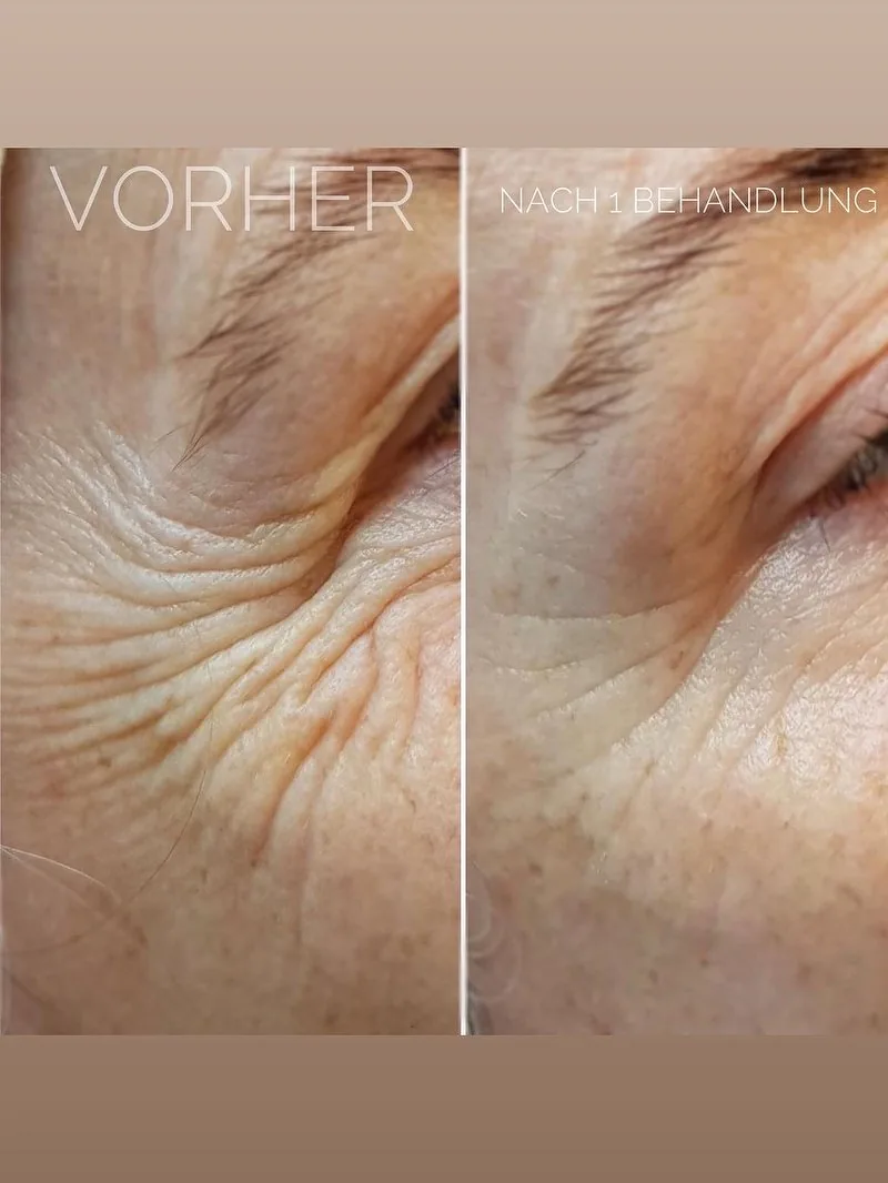 Vorher-nachher einer Anti-Aging-Behandlung